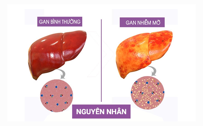 Gan nhiễm mỡ có nguy hiểm không? Dấu hiệu & bí quyết phòng bệnh