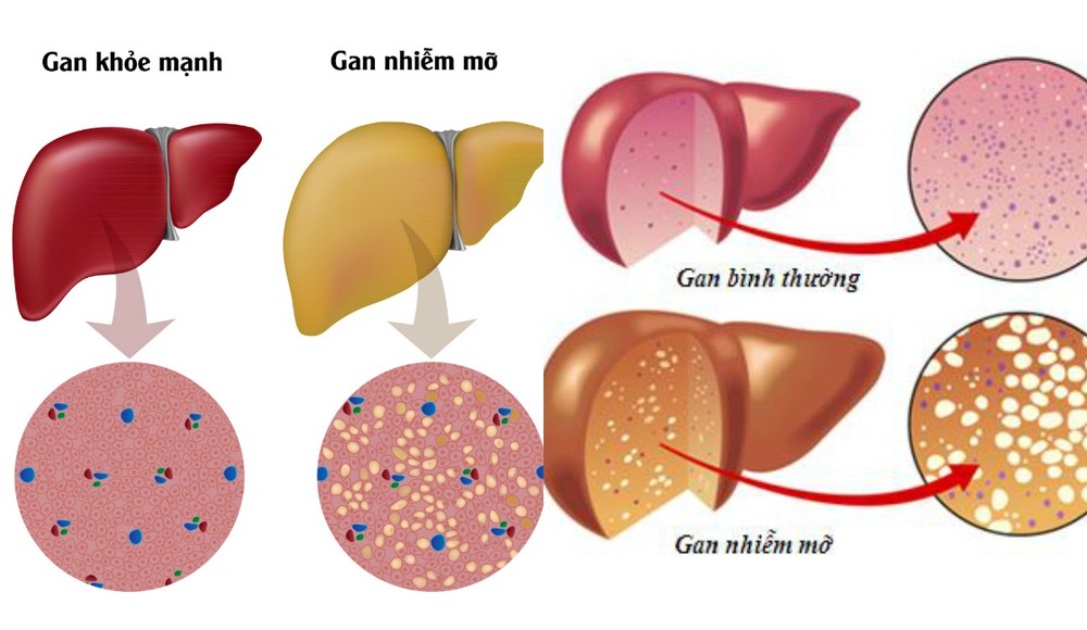 gan nhiễm mỡ có nguy hiểm không