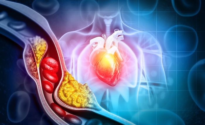 Giảo cổ lam giúp làm giảm cholesterol trong máu, ngăn ngừa xơ vữa động mạch 