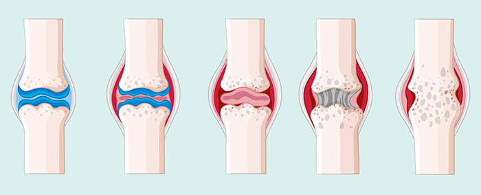 Khô khớp nên bổ sung gì để tăng dịch nhờn và tái tạo sụn khớp?