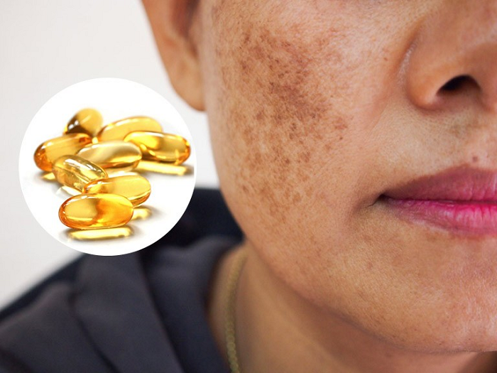 cách trị nám bằng Vitamin E