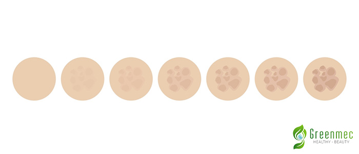 Sự xuất hiện của tàn nhang