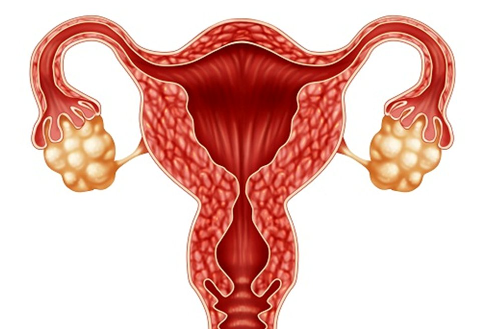 bữa sáng cho người buồng trứng đa nang