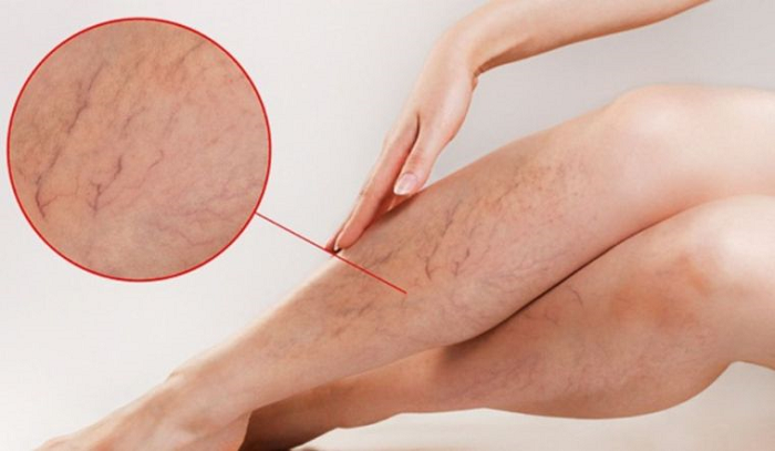 giãn tĩnh mạch ở bà bầu