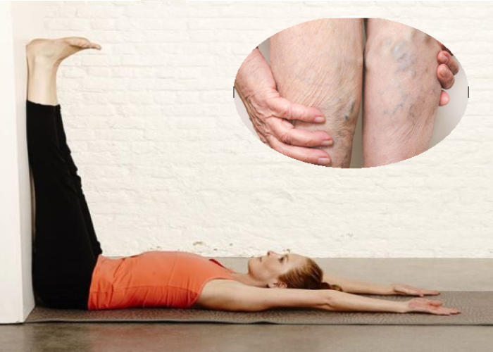 giãn tĩnh mạch tập thể dục như thế nào