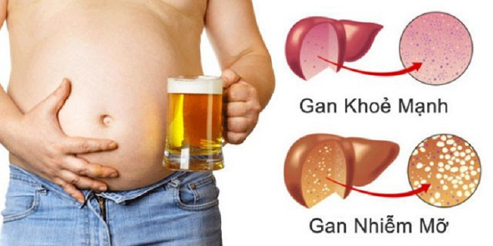 chỉ số gan nhiễm mỡ