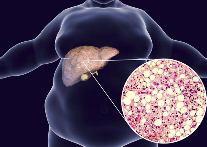 gan nhiễm mỡ ăn trứng được không